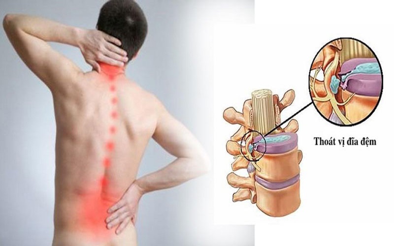 Massage toàn thân giúp điều trị thoát vị đĩa đệm hiệu quả