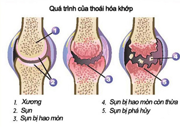 ghế massage cho người bệnh xương khớp